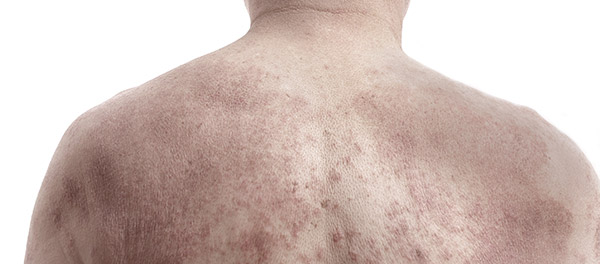 Seborrheic dermatitis - photo